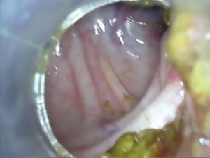 Deep deep anal again home colonoscopy endoscope part 1